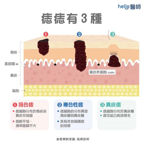 陰囊痣|陰囊長痣？5大原因揭秘